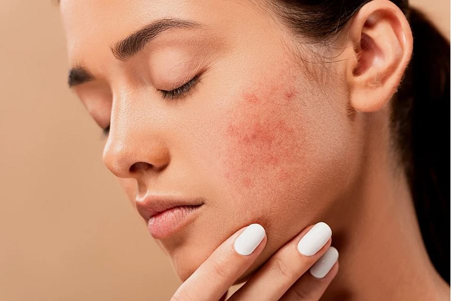 CBD and skincare may help with acne